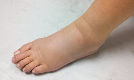 Penyakit Kaki Gajah Karena Adanya Infeksi Cacing Parasite Filaria